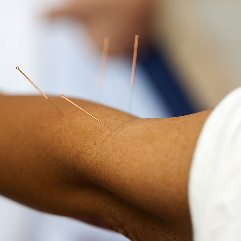 Acupuncture for workers' comp in Fresno, CA